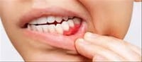 Pyria Home Remedy Shared by Acharya Balkrishna: Clove Oil-Based Natural Care